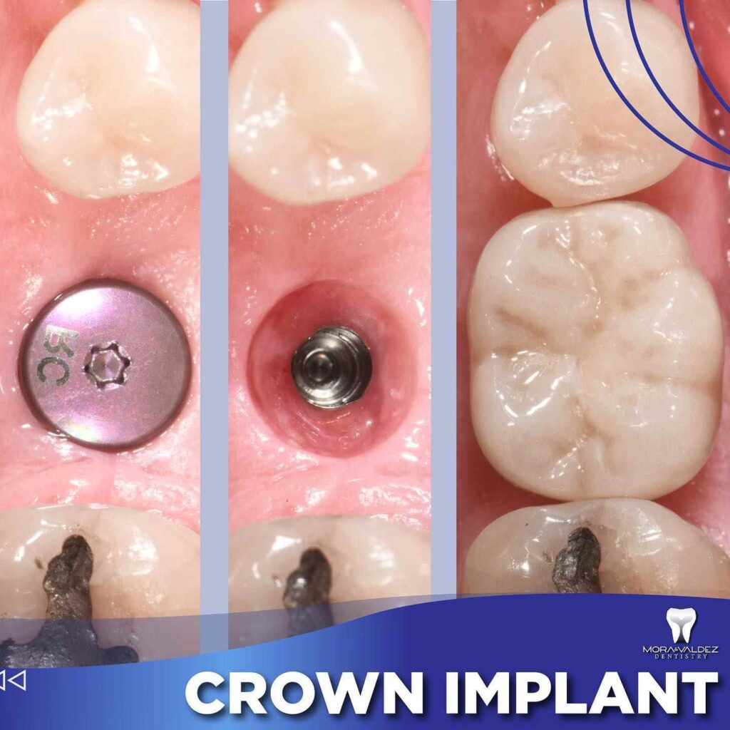 Implant Rehabilitation​